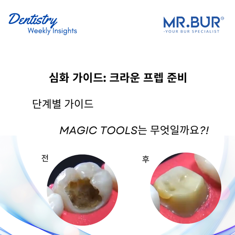 사전 가이드: 사후 크라운 준비를 위한 10단계