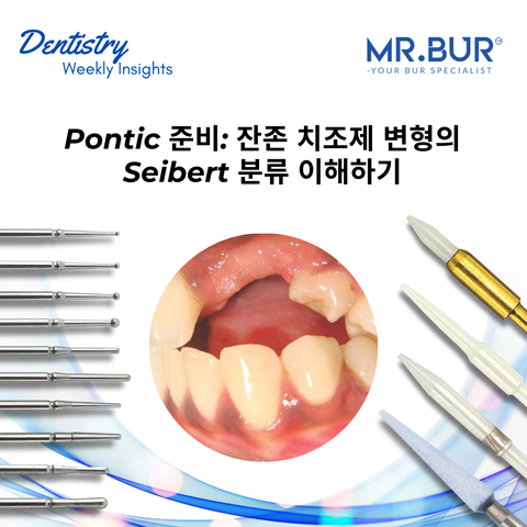 Pontic preparation techniques using Seibert’s classification of residual ridge deformities, Mr. Bur Soft Tissue burs provide precise solutions for ridge augmentation and optimal prosthetic outcomes