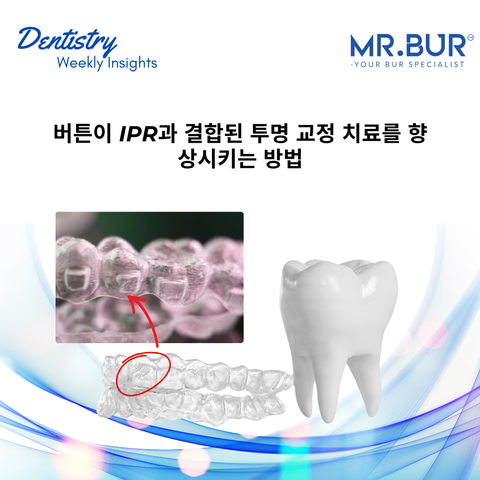 Buttons enhance clear aligner treatment by improving control and precision, integrated with IPR using Mr. Bur One Slice IPR Kit.