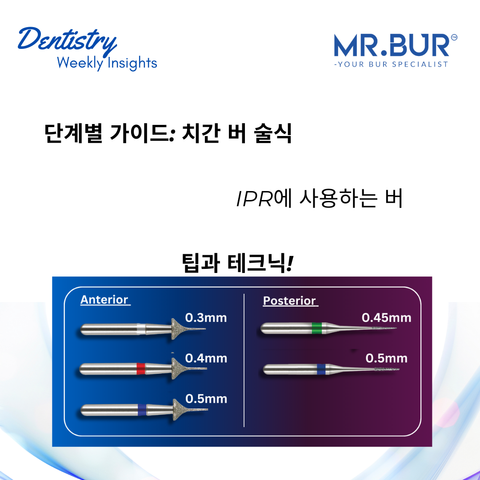 근위부 버 기법에 대한 단계별 가이드: IPR에 사용되는 버