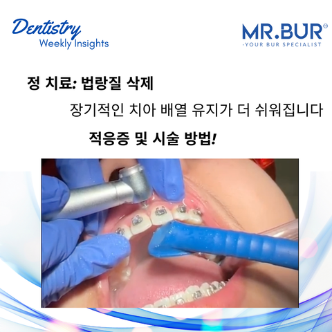 치과 인사이트: 교정 치료의 에나멜 감소 절차