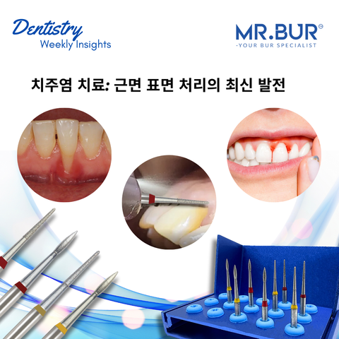 Advances in root surface treatment with precision tools like Mr. Bur Surgical Root Planing Kit for improved gum health and attachment.