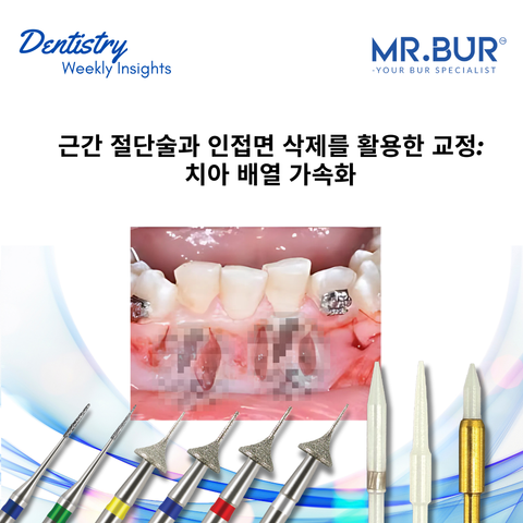 Corticotomy-Assisted Orthodontics with Interproximal Reduction accelerates dental alignment using advanced tools like Mr. Bur One Slice IPR Kit.
