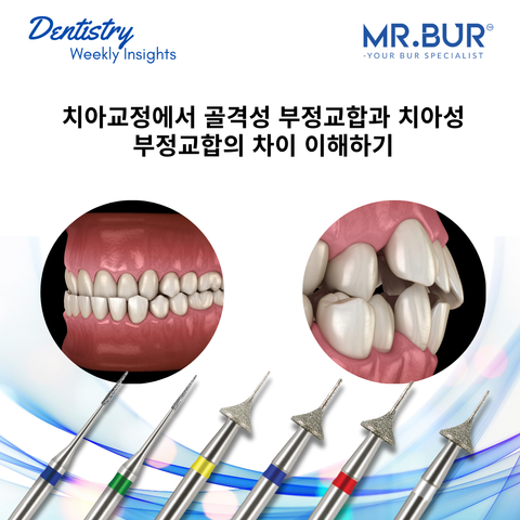 Understanding skeletal malocclusion vs dental malocclusion in orthodontics, Mr. Bur explores causes, diagnosis, and treatment strategies for optimal outcomes such as Mr Bur Interproximal Reduction Bur.