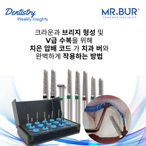 치은 후퇴 코드가 크라운 및 브리지 준비와 클래스 V 복원을 위해 치과 버와 완벽하게 작동하는 방법