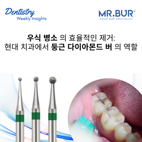 충치 병변의 효율적인 제거: 현대 치과에서 둥근 다이아몬드 버의 역할