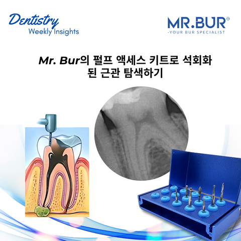 Mr. Bur Pulp Access Kit로 석회화 근관을 안전하게 탐색하는 방법