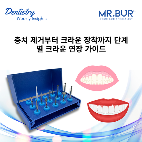 충치 제거부터 크라운 장착까지: 단계별 크라운 연장술 가이드