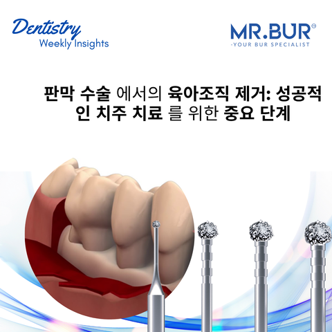  Degranulation in Flap Surgery & Crucial Steps for Successful Periodontal Treatment using Mr. Bur Degranulation Kit
