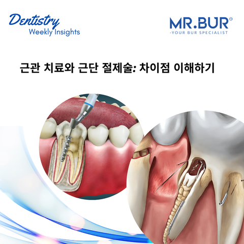 근관치료 vs. 근단절제술: 차이점 이해하기